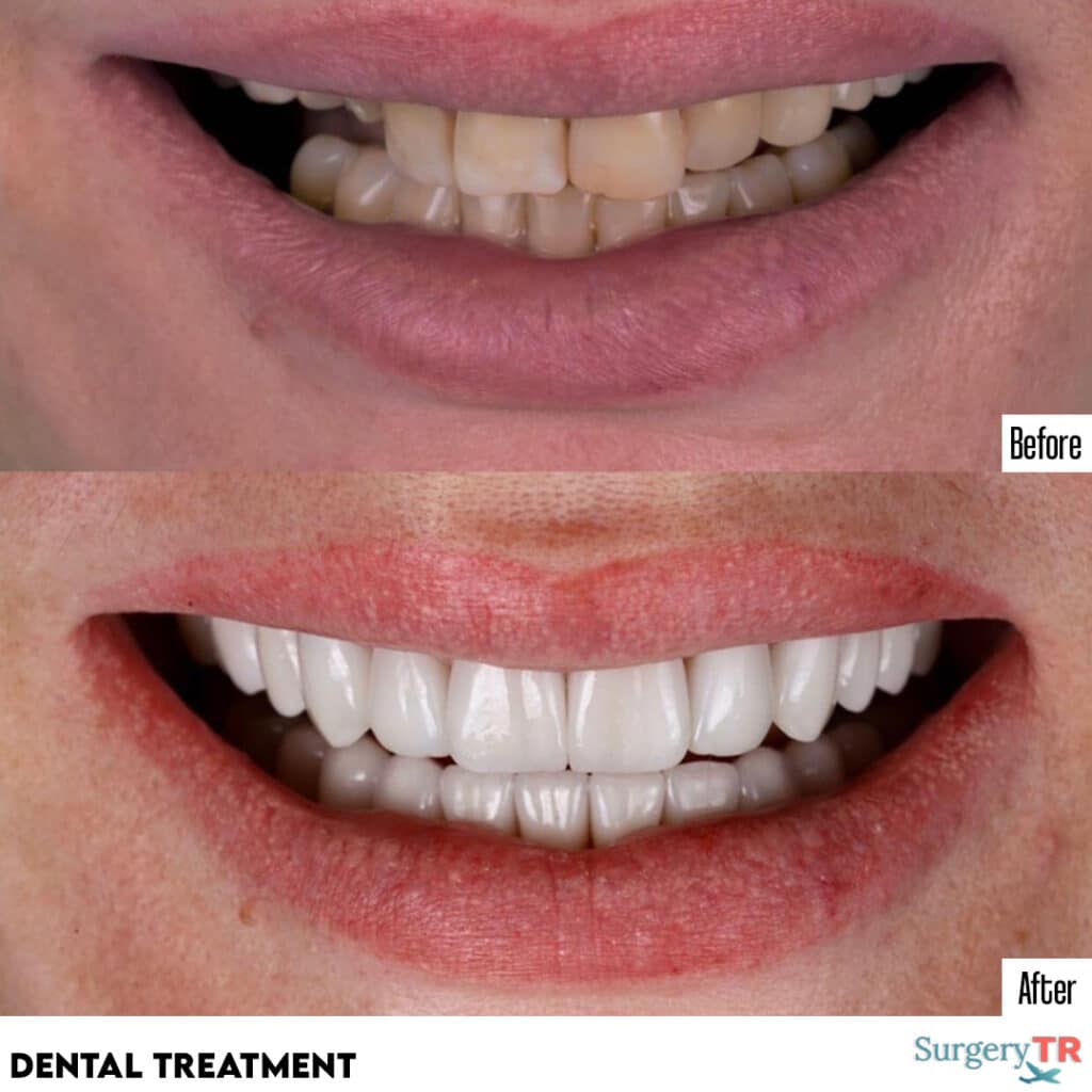 Teeth Whitening In Turkey Packages SurgeryTR