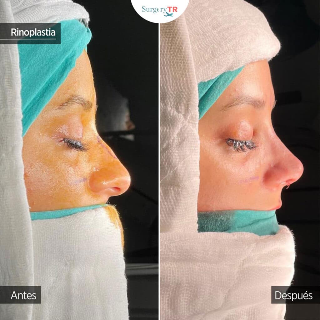 Rinoplastia En Turqu A Cirug A De Nariz Surgerytr