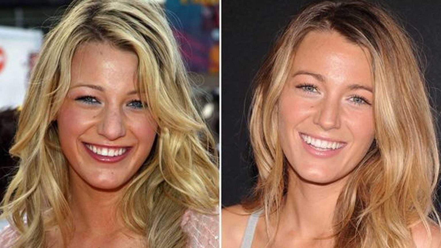 Blake Lively: Eyelid And Nose Job Surgery | SurgeryTR