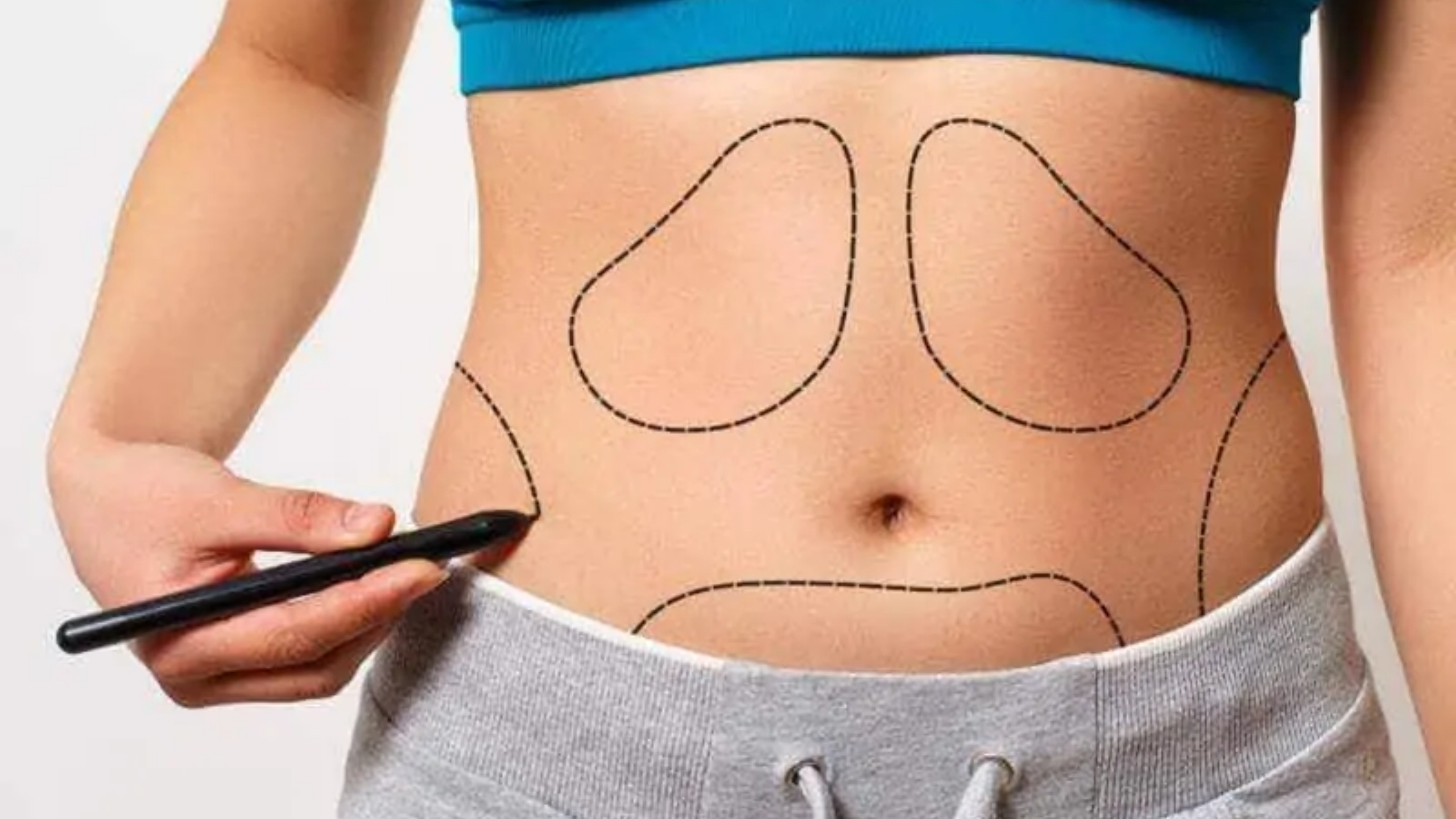 Can Liposuction Reduce Belly Fat? A Comprehensive Guide to Targeting Abdominal Fat