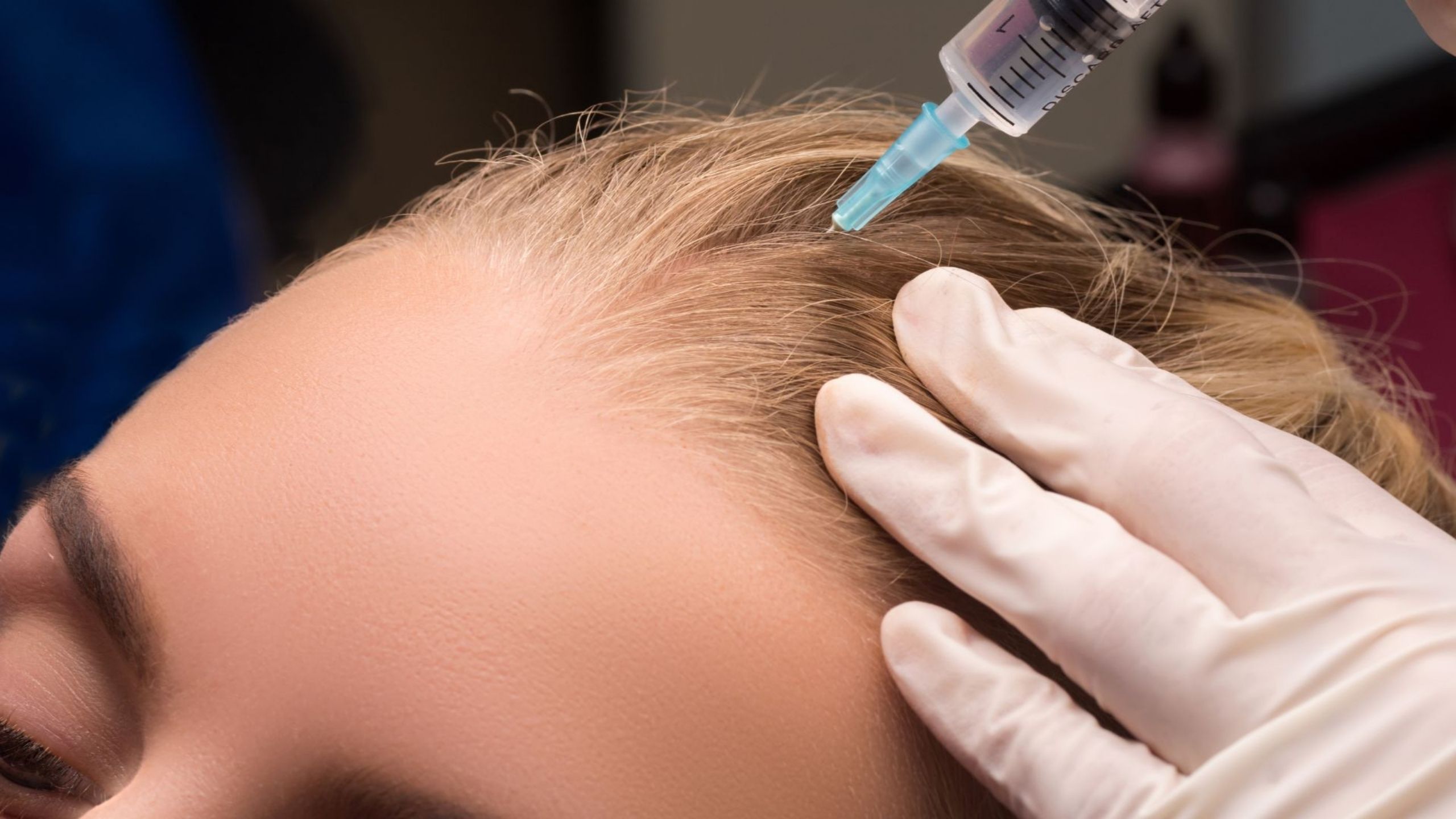 Mesotherapy for Hair: An Effective Alternative Treatment